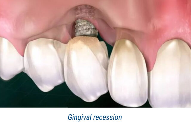 Gingival recession