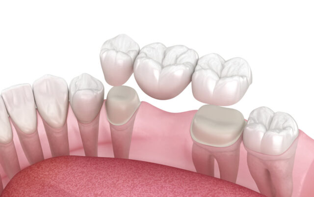 What is a dental bridge? Illustration
