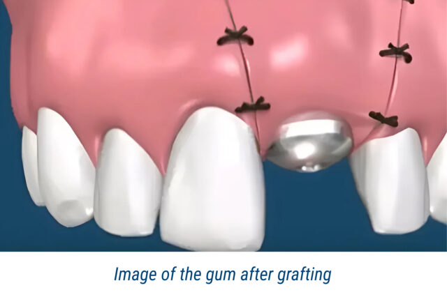 Image of the gum after grafting