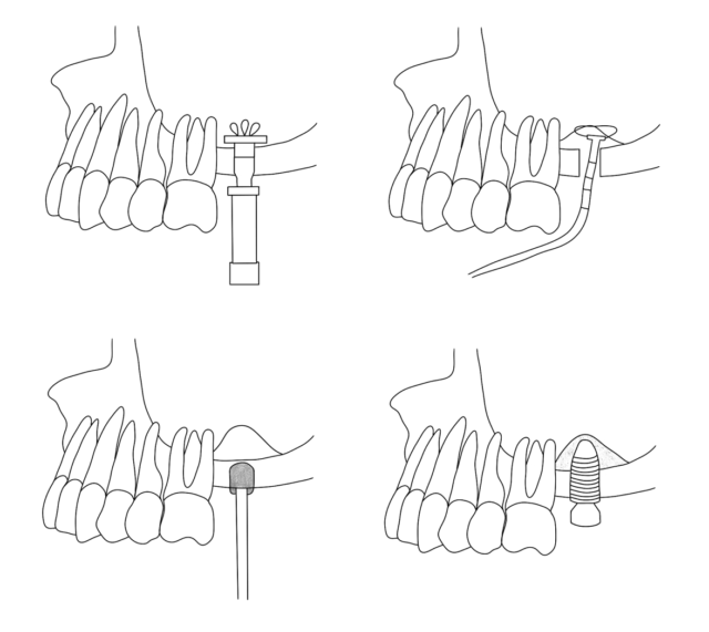 Closed Sinus Lift Illustration