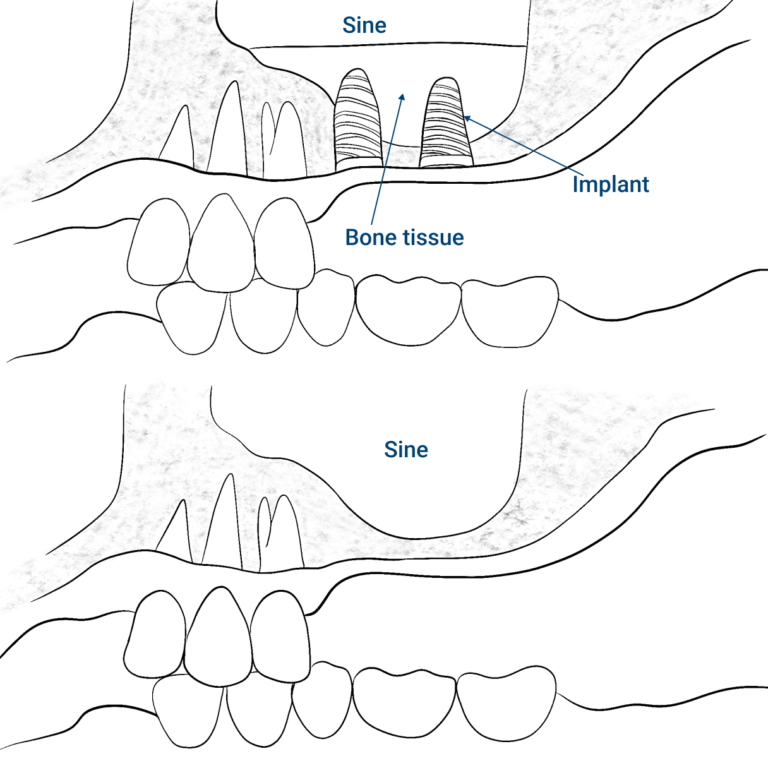 image-sinus-lift-15_EN
