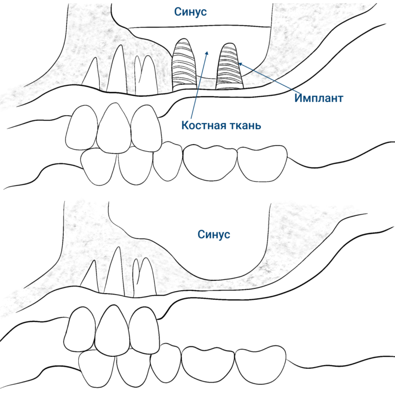 image-sinus-lift-15_RU