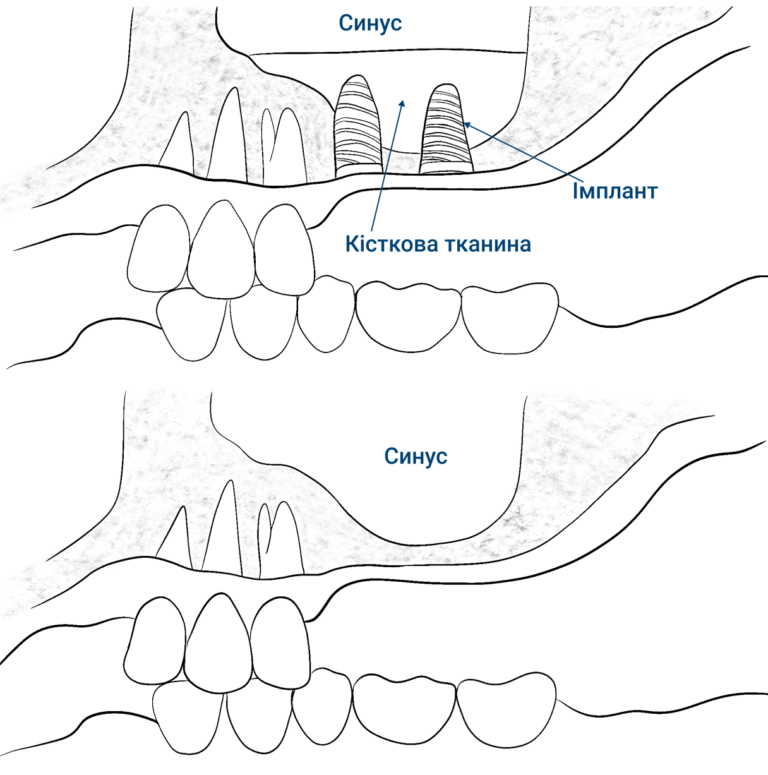 image-sinus-lift-15_UA