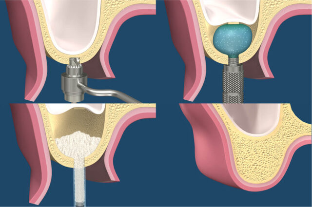 Balloon Sinus Floor Elevation Illustration