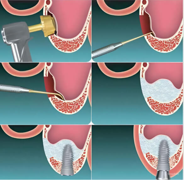 Open or Lateral Sinus Lift Illustration