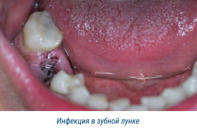 Инфекция в зубной лунке