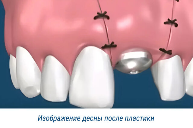 Изображение десны после пластики