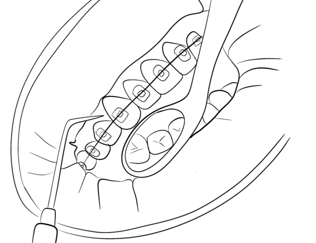 Ceramic Braces Placement Illustration