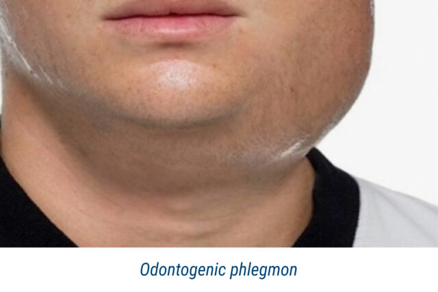 Odontogenic phlegmon