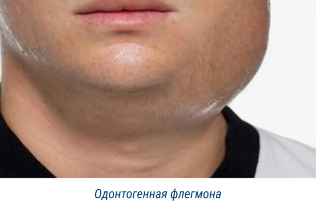 Одонтогенная флегмона