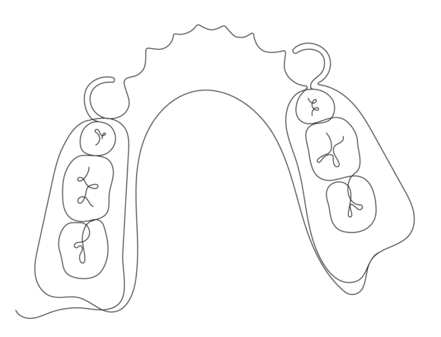 What are clasp dentures Illustration