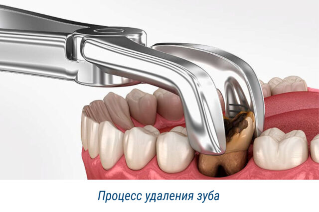 Процесс удаления зуба