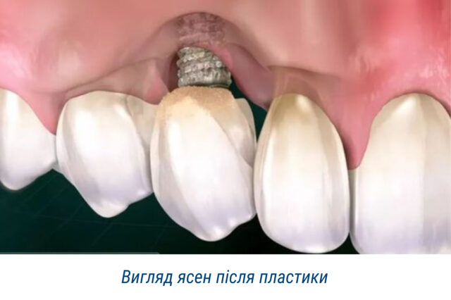 Рецесія ясен