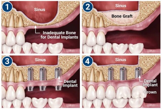 Sinus lift as a method of bone augmentation Illustration