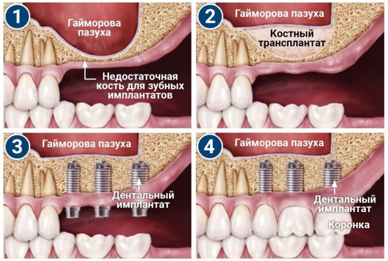 Sinus_4_RU