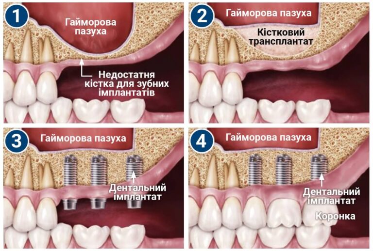 Sinus_4_UA
