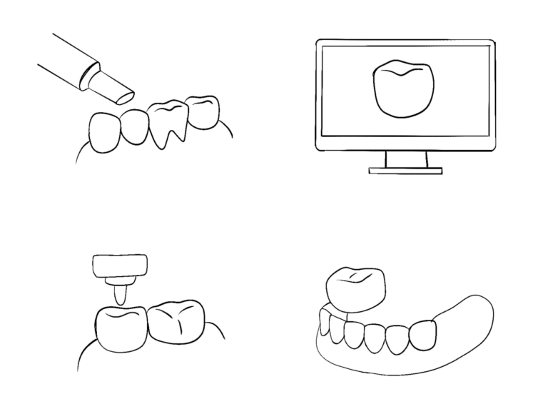tooth-crown+inlay-07
