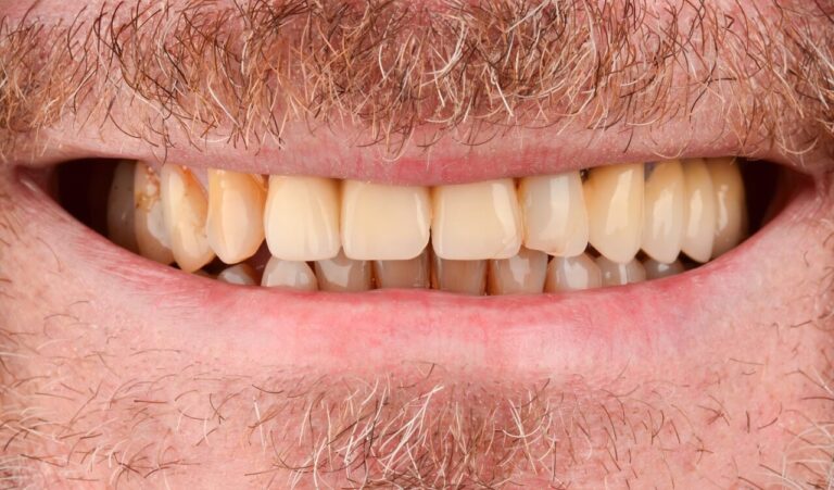 Total restoration with zirconium crowns