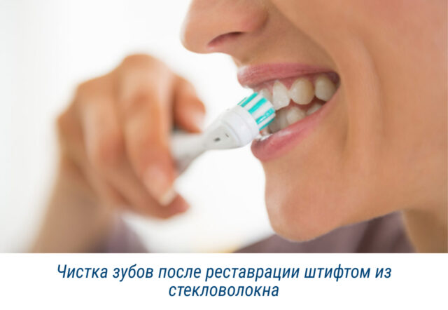 Чистка зубов после реставрации штифтом из стекловолокна