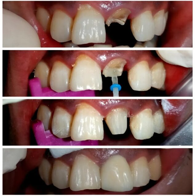 Stages of restoration of an anterior tooth with a fibreglass post