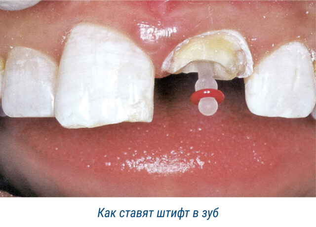 Как ставят штифт в зуб