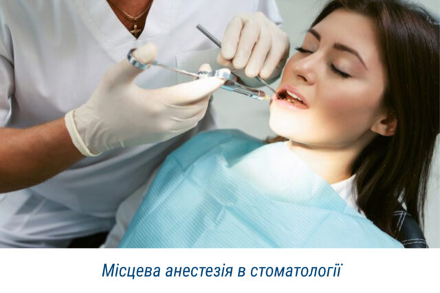 Місцева анестезія в стоматології