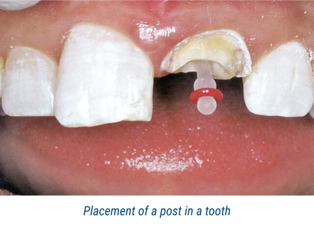 Placement of a post in a tooth