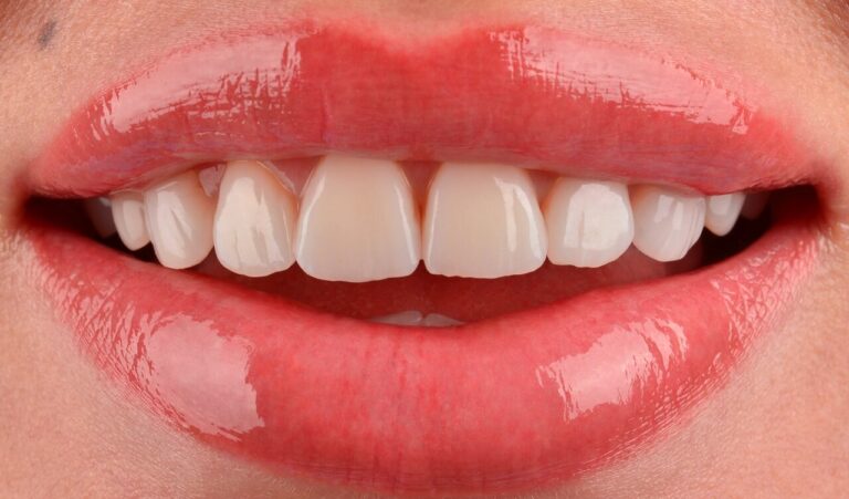 How long do veneers last? A case of replacing old ceramic restorations