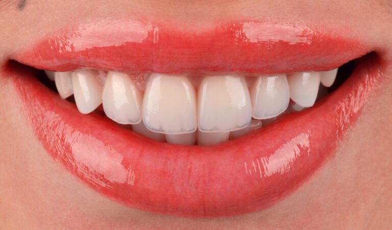 How long do veneers last? A case of replacing old ceramic restorations