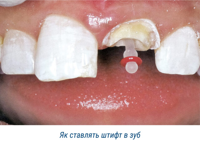 Як ставлять штифт у зуб