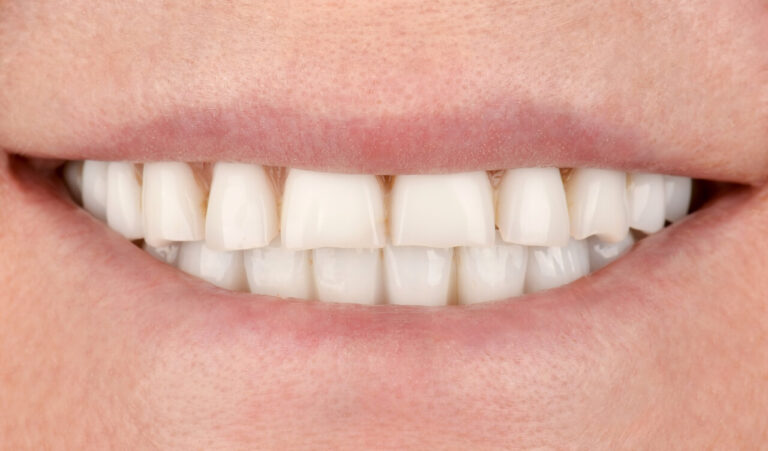 New zirconia prosthesis for upper jaw in 12 days