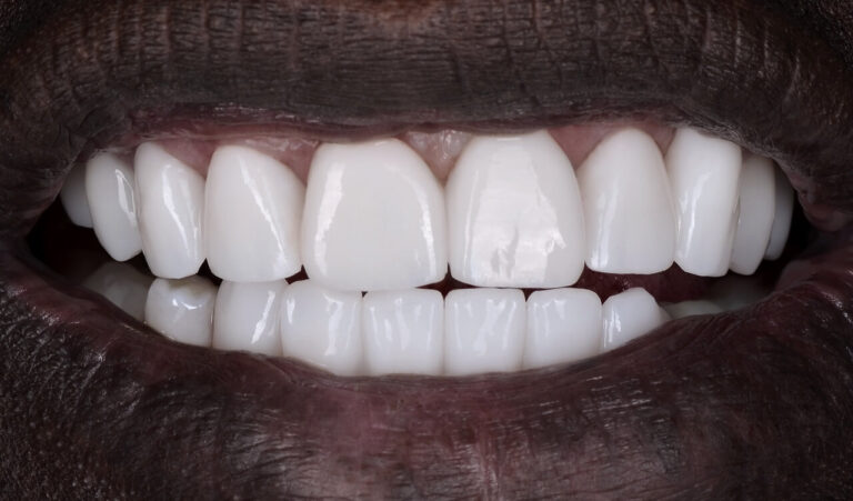 Total prosthetics with zirconia crowns in 5 days