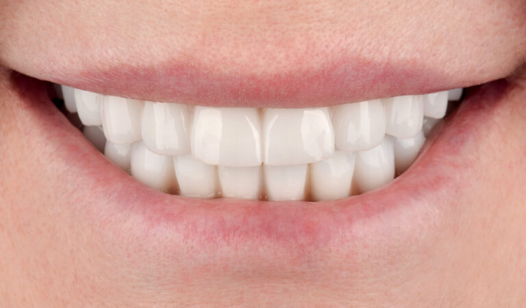 New zirconia prosthesis for upper jaw in 12 days