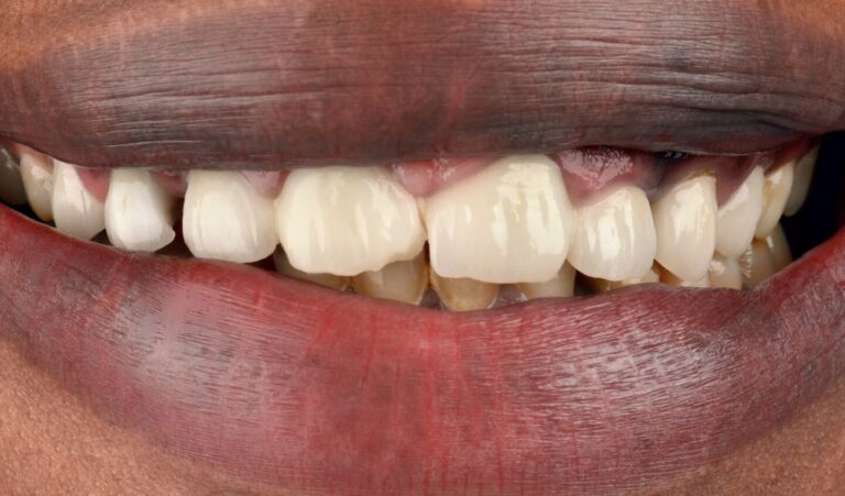 Restoration of several zirconium crowns and aesthetic correction of the lower jaw in 8 days