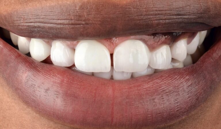 Restoration of several zirconium crowns and aesthetic correction of the lower jaw in 8 days