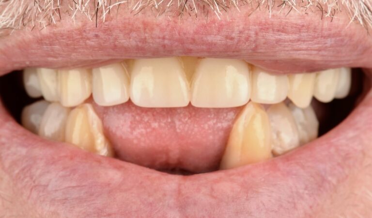 Rehabilitation according to the All-on-6 protocol: implantation and prosthetics with zirconium crowns