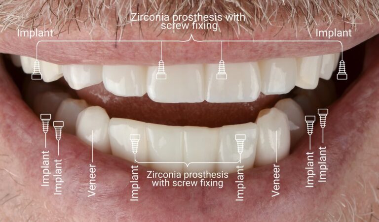 Rehabilitation according to the All-on-6 protocol: implantation and prosthetics with zirconium crowns