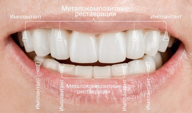 Реабилитация пациента с выраженной дентальной фобией по протоколу All-on-4