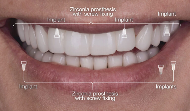 Prosthetic scheme using implants and ceramic crowns.