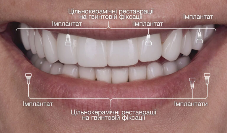 Схема протезування з використанням імплантатів і керамічних коронок.