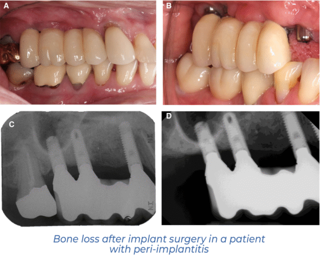 Bone loss after implant surgery in a patient with peri-implantitis