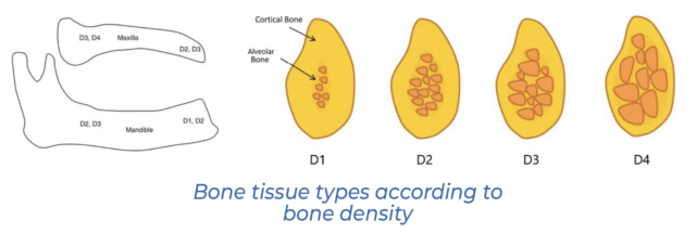 Bone tissue types according to bone density