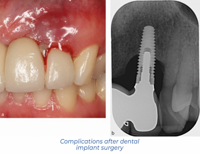 Complications after dental implant surgery