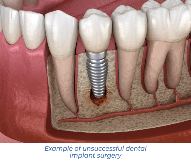 Example of unsuccessful dental implant surgery