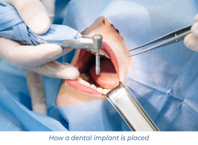 How a dental implant is placed