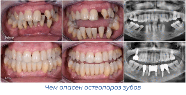 Чем опасен остеопороз зубов