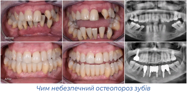 Чим небезпечний остеопороз зубів
