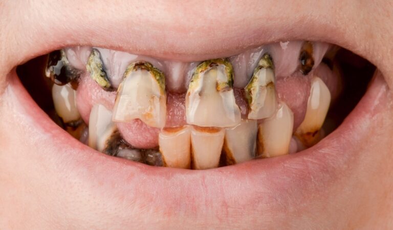 Alpha-Bio Implant Price. Photo before