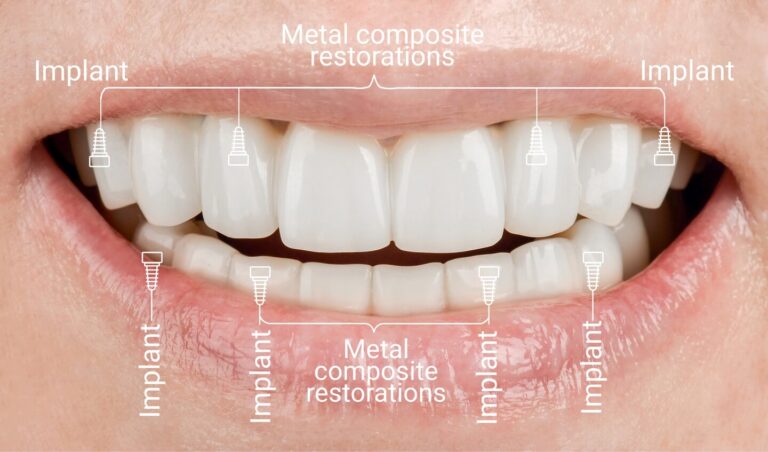 Alpha-Bio Implant Price. Photo after