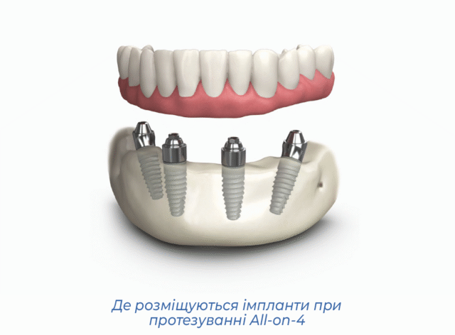  Де розміщуються імпланти при протезуванні All-on-4
